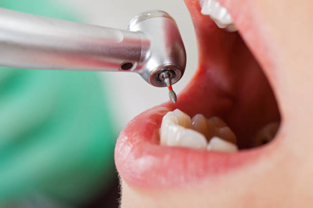Best Emergency Tooth Extraction in Boalsburg, PA